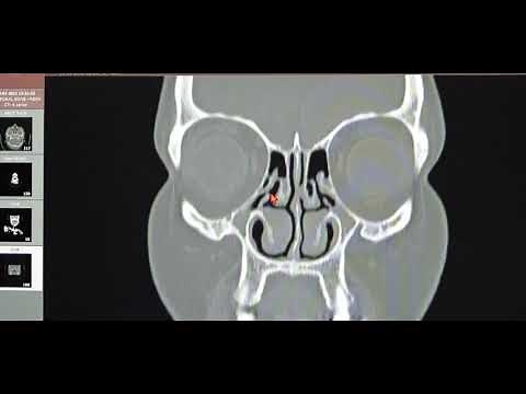 When to Operate for FESS in Chronic Bilateral Pansinusitis with Neo-osteogenesis? CT PNS Basics