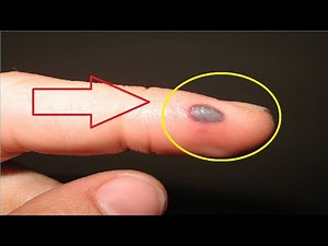 how to get rid of a blood blister that won't go away