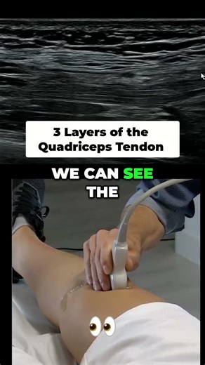 Quadriceps Tendon Ultrasound: The 3-Layer Pattern Explained