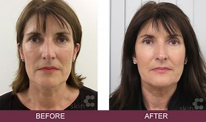 Sculptra The Liquid Facelift | Skin Excellence Clinic