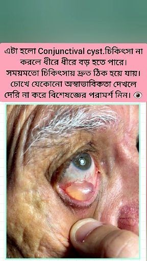 এটা হলো Conjunctival cyst.চিকিৎসা না করলে ধীরে ধীরে বড় হতে পারে।সময়মতো চিকিৎসায় দ্রুত ঠিক হয়ে যায়। চোখে যেকোনো অস্বাভাবিকতা দেখলে দেরি না করে বিশেষজ্ঞের পরামর্শ নিন। 👁️ #conjunctivalcyst #eyeproblems | Dr. S Hasan- ডা: এস হাসান