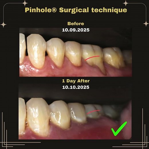 1 Day After Pinhole® Surgery — Instant Gum Renewal! 🌿✨