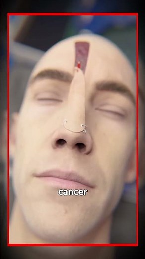 Forehead Flap Surgery: How a New Nose is Rebuilt After Skin Cancer Removal#surgery #cancer