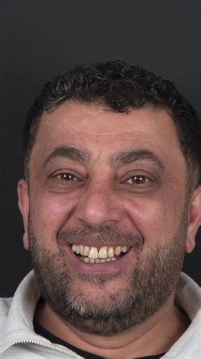 ئەنجامدانی هۆڵیوود سمایل لەلایەن دکتۆر شاد یوسف زەردەخەنەکەت گرینگە بۆیە بە ئێمەی بسپێرە ناونیشان هەولێر جووت سایدی برایەتی نزیک ماڕکێتی کۆك و ئایە 0750 918 45 45 0772 918 45 45