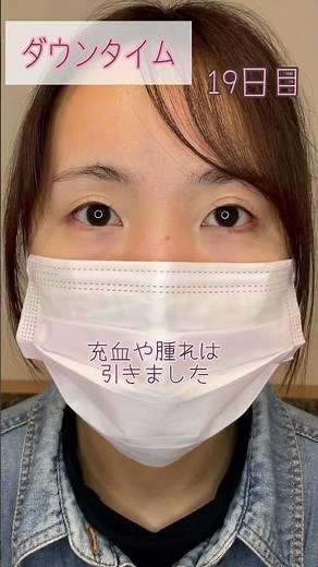 【目尻切開/たれ目形成（たれ目尻切開）】術前→術後2カ月