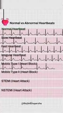 💓 Normal vs Abnormal Heartbeats | ECG Patterns Explained | STEMI, NSTEMI, Heart Block #viral #shorts