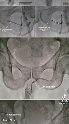 Treatment of erectile dysfunction caused by Venous leakage by interventional coil embolization