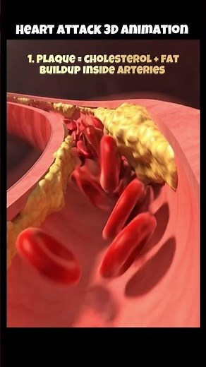 What Really Happens During a Heart Attack (3D Animation)