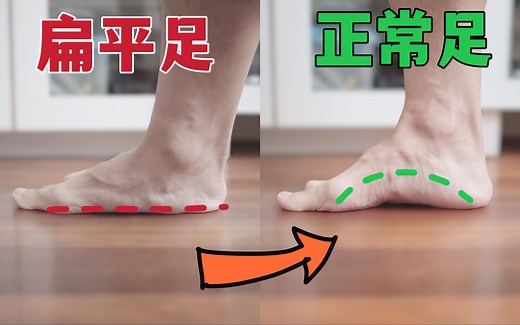 扁平足自救指南｜自测、自救的完整方法