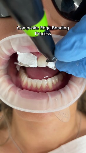 Dr Hamzah Completing Composite Edge Bonding