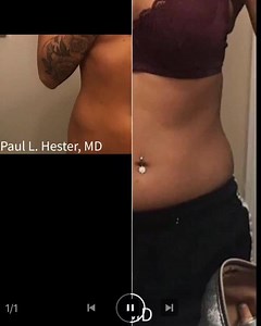 BodyTite 3 Month Results