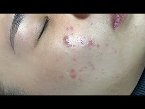 remove hidden acne for you new customer LinhMyDang #byMyAnhDang #048