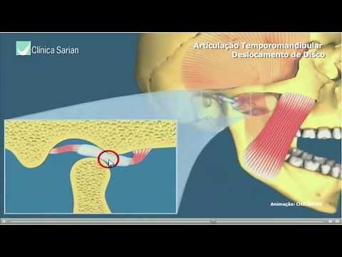 Articulação Temporomandibular Deslocamento de Disco