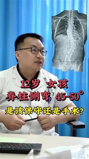 12岁女孩脊柱侧弯40-45度#脊柱侧弯 #脊柱侧弯矫正 #医学科普 #小儿骨科 #抖出健康知识宝藏