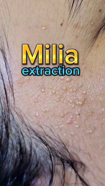 What is Milia? Causes, Treatment, and Extraction Options