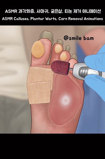ASMR 과각화증, 사마귀, 굳은살, 티눈 제거 애니메이션 Calluses, Plantar Warts, Corn Removal Animations#ASMR #fyp #추천 #SOONENT #treatment #care #케어 #animation #틱톡뷰티