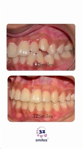 From crowded teeth to a confident smile! 😁✨ Real results. Perfect alignment. Beautiful smiles. 🦷🌟