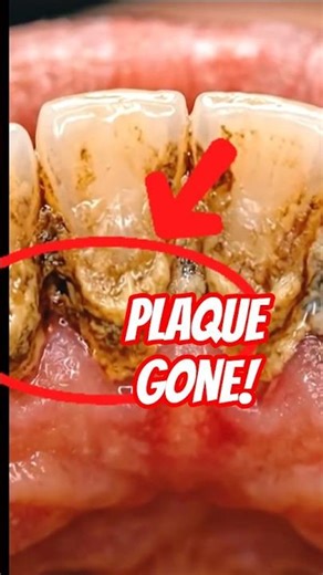 Plaque Removal Transformation 😳 From Dirty Teeth to Perfect Clean