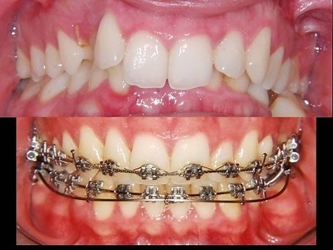 Amazing Deep Bite Correction: Orthodontist!