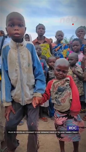 Kwashiorkor is a severe form of malnutrition caused by protein deficiency and often occurs in children between 1 and 3 years of age, particularly after weaning. Symptoms include edema (swelling) of the lower limbs, discolored and brittle hair, and skin lesions. An infection can trigger kwashiorkor, and children with the condition are very vulnerable to infections. Treatment involves gradually reintroducing protein into the diet and managing any infections. Causes and Risk Factors Protein Deficie