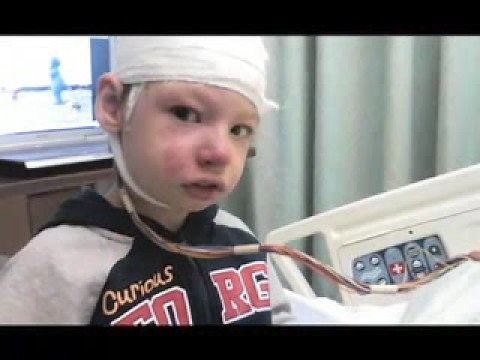 Hemispherectomy for Sturge-Weber Syndrome
