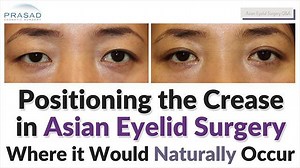 The Doctor Explains Asian Eyelid Surgery Options and Results