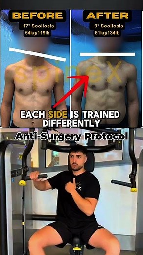 Scoliosis Exercise for Uneven Shoulders #scoliosis