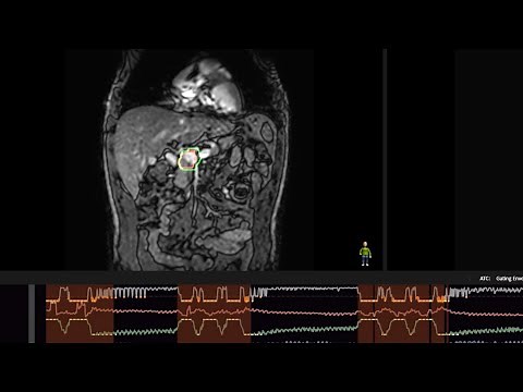 MR-linac Comprehensive Motion Mangement