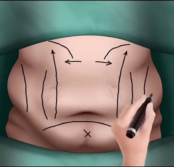 So this is how liposuction works #fyp #foryou #tiktok #cartoon #asmr #anime #animation #liposuction