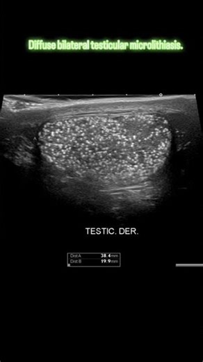 diffuse bilateral testicular microlithiasis
