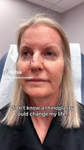 In LOVE with our patient’s new found confidence!! Rhinoplasty by Dr. Rob Sigal at the Austin-Weston Center in Reston, Virginia 💜 #nosejob #trusttheprocess #beforeandafter #confident
