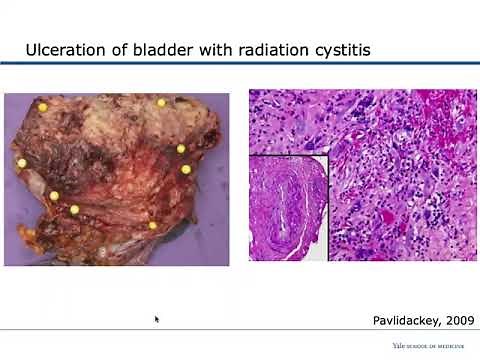 Management of Radiation-Induced Hemorrhagic Cystitis