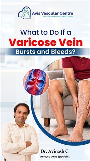 What to Do If a Varicose Vein Bursts and Bleeds? | Dr. Avinash