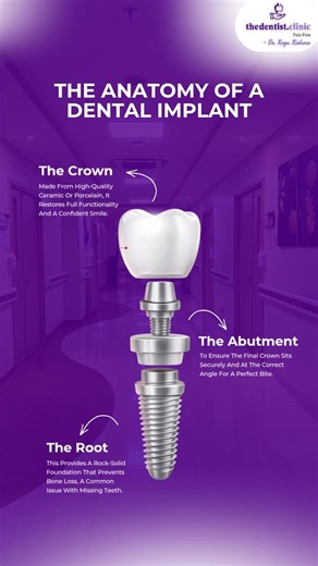 thedentist.clinic presents: Understanding the Anatomy of a Dental Implant