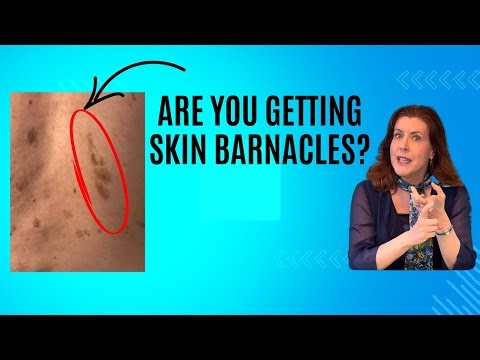 In office and DIY treatments for seborrheic keratoses -surprising tips you wish you knew years ago.
