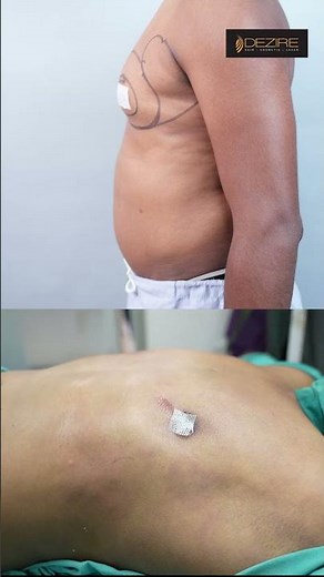 Gynecomastia Surgery