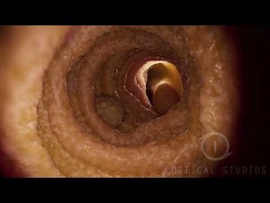 Bowel Cleansing in Colonoscopy - Cortical Studios