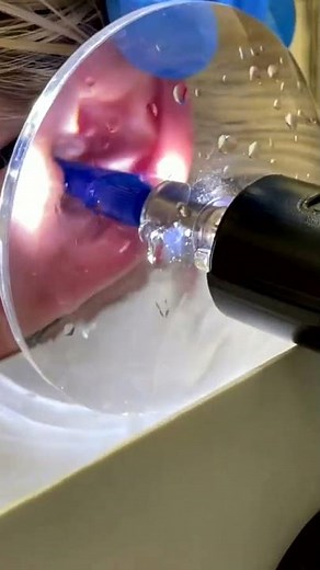 Newest pimple removal 2022 - Cystic acne extractions whiteheads new