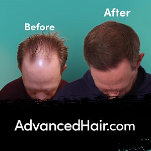 *#1 Hair Loss Solution in Dallas* Hair restoration changes lives. We helped 40,000 patients get their hair and confidence back. Why Advanced Hair? ✅ Simple 1-day procedure ✅ Uses your real hair ✅ Permanent results Book a free consultation with Advanced Hair today! | Advanced Hair Restoration