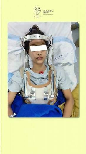 C1 Vertebra Fracture(Jefferson Fracture) Successfully Treated WITHOUT Surgery! | Halo Brace Recovery