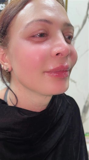 Lip Fillers and Aesthetic Treatments with Dr. Yasir