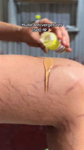 Tu as des vergetures ? Tu veux les enlever mais tu as un petit budget ? Chez MES VERGETURES, a moindre coût tu peux avoir un produit pour te débarrasser efficacement et sans risque tes vergetures. Commande maintenant !!! 📞 05 65 09 38 28