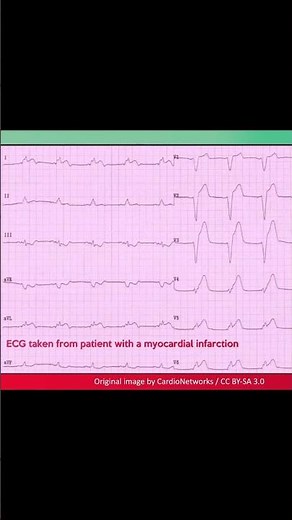 Left bundle branch block (LBBB) ECG: Example 10