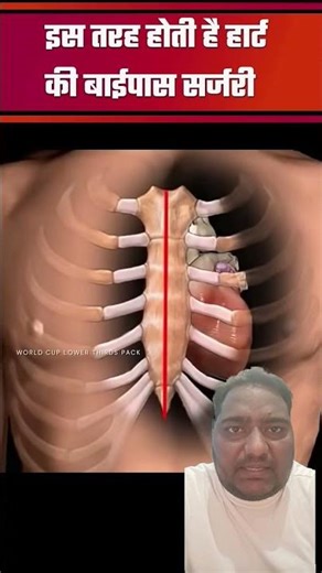 "Heart Bypass Surgery Kaise Hoti Hai? | Step by Step Explained 🔥 #trendingshorts"