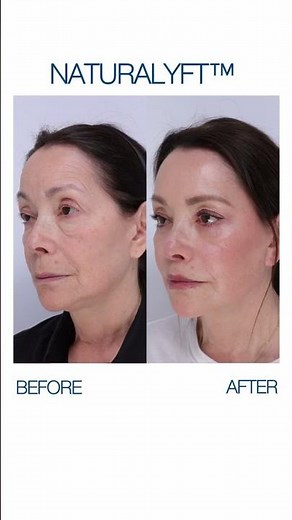 76 years old Before and After Facial Rejuvenation with Dr. Madnani