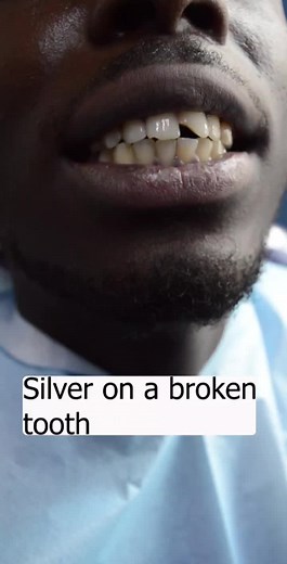 Silver Teeth: Permanent Solution for Broken Teeth