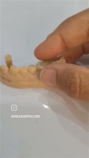 Dental Overlays - a conservative way to save your tooth.