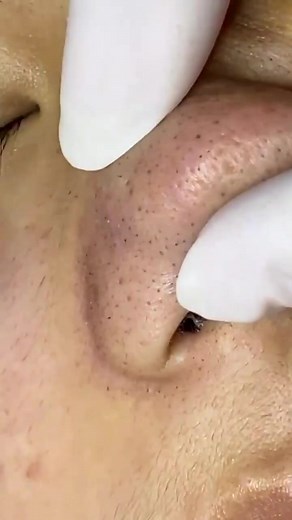 blackheads removal from the nose 🪱🪱#blackhead #acne #pimple #fyp #satisfying #foryou #blackheadsremoval #blackheads