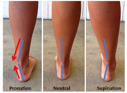 Why Are My Ankles Turned Inward? | Dr. Lance Silverman