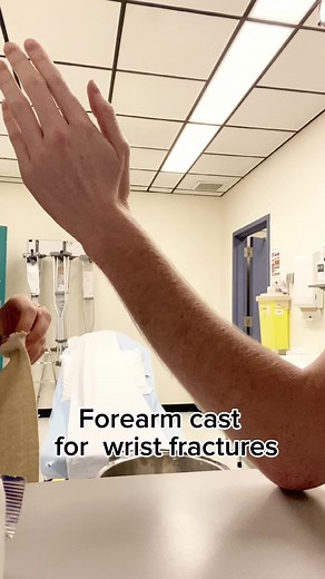 Hi! This is a forearm cast, a treatment for wrist fractures. Made with synthetic fiberglass cast, it usually stays in place for 4-6 weeks depending on the case. Have you ever broke a bone? Tell me about it! #forearmcast #cast #orthopediccast #orthopedics #fracture #casttechnician #ortho #work